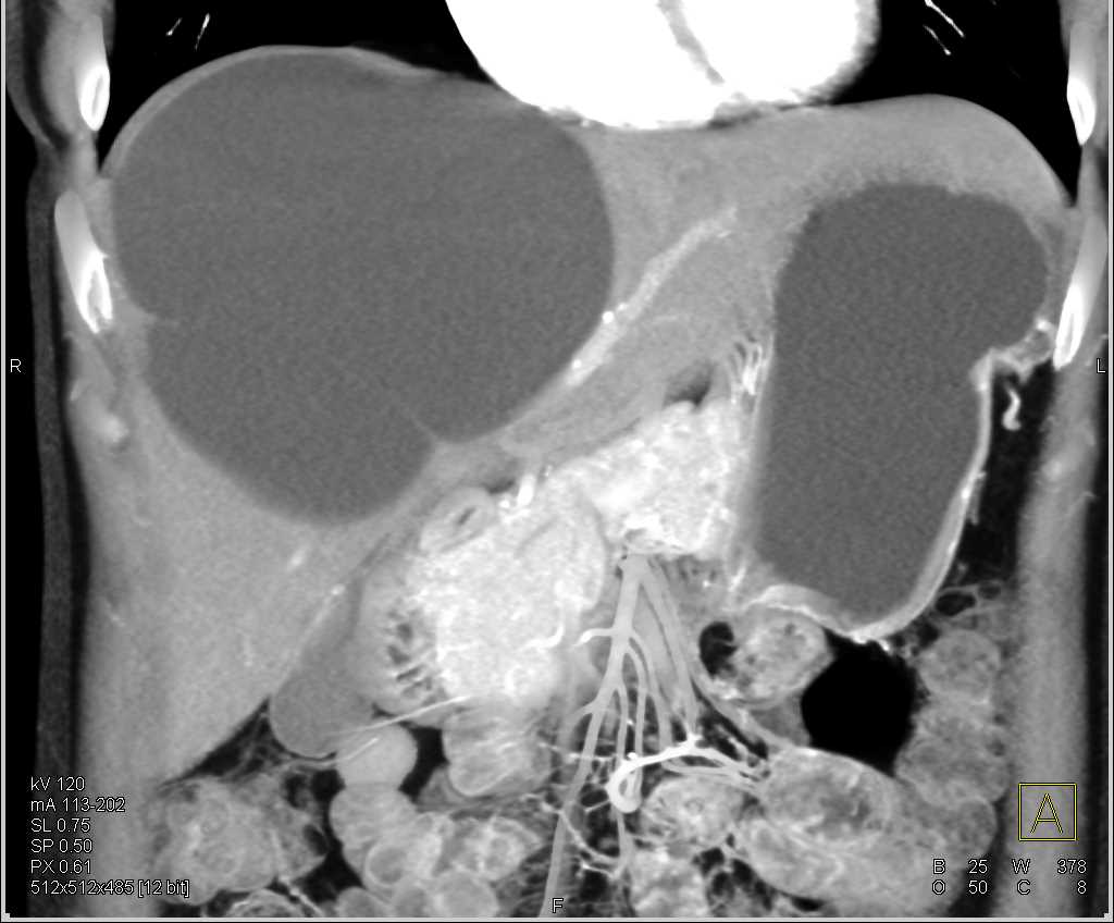 Simple Hepatic Cyst - CTisus CT Scan