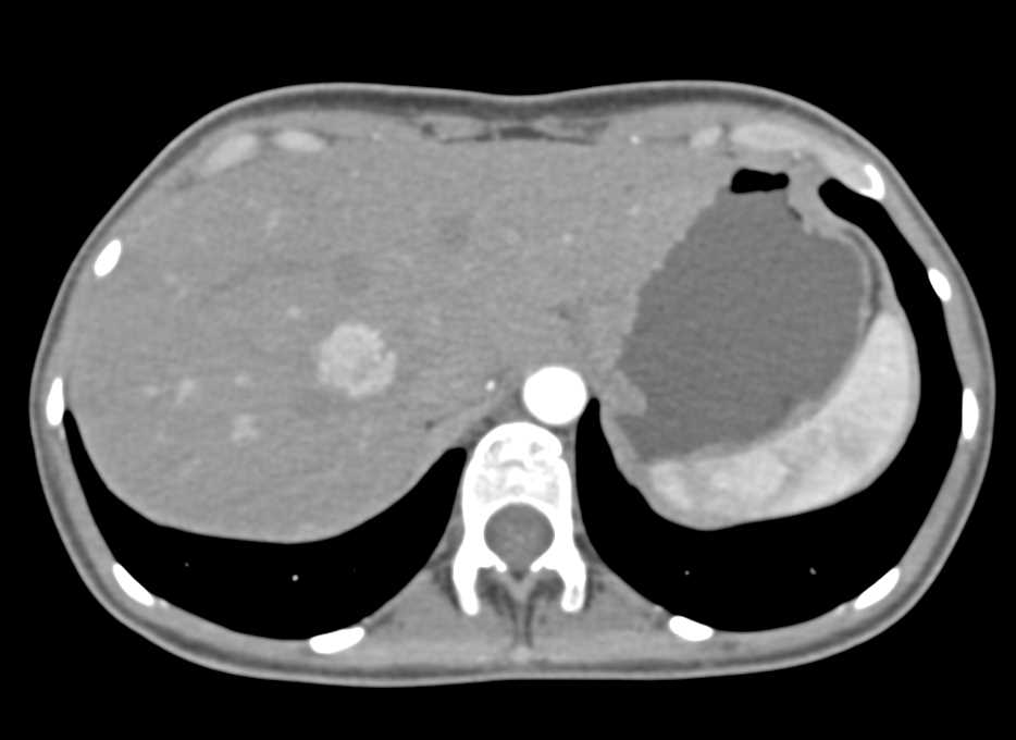 Focal Nodular Hyperplasia Liver Mass - CTisus CT Scan