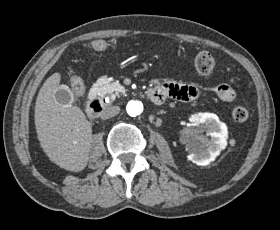 Distal Common Bile Duct Cholangiocarcinoma - CTisus CT Scan