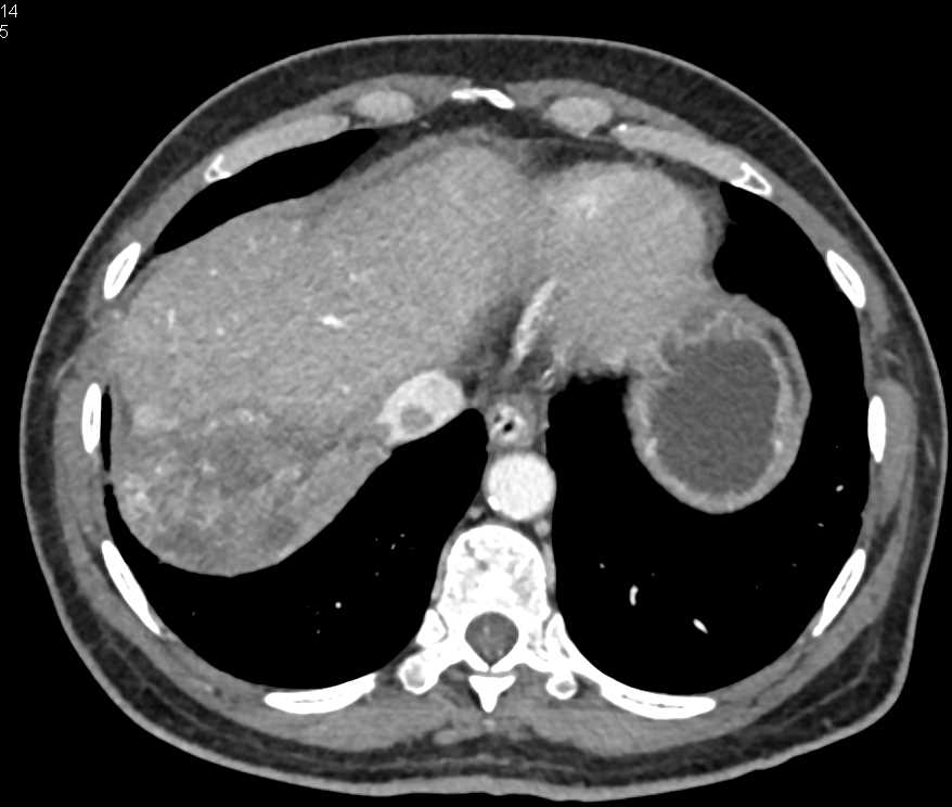 Hepatocellular Carcinoma (Hepatoma) Invades the Inferior Vena Cava (IVC) - CTisus CT Scan