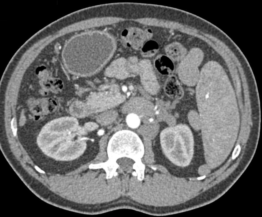 Large Varices Which Simulate Adenopathy - CTisus CT Scan