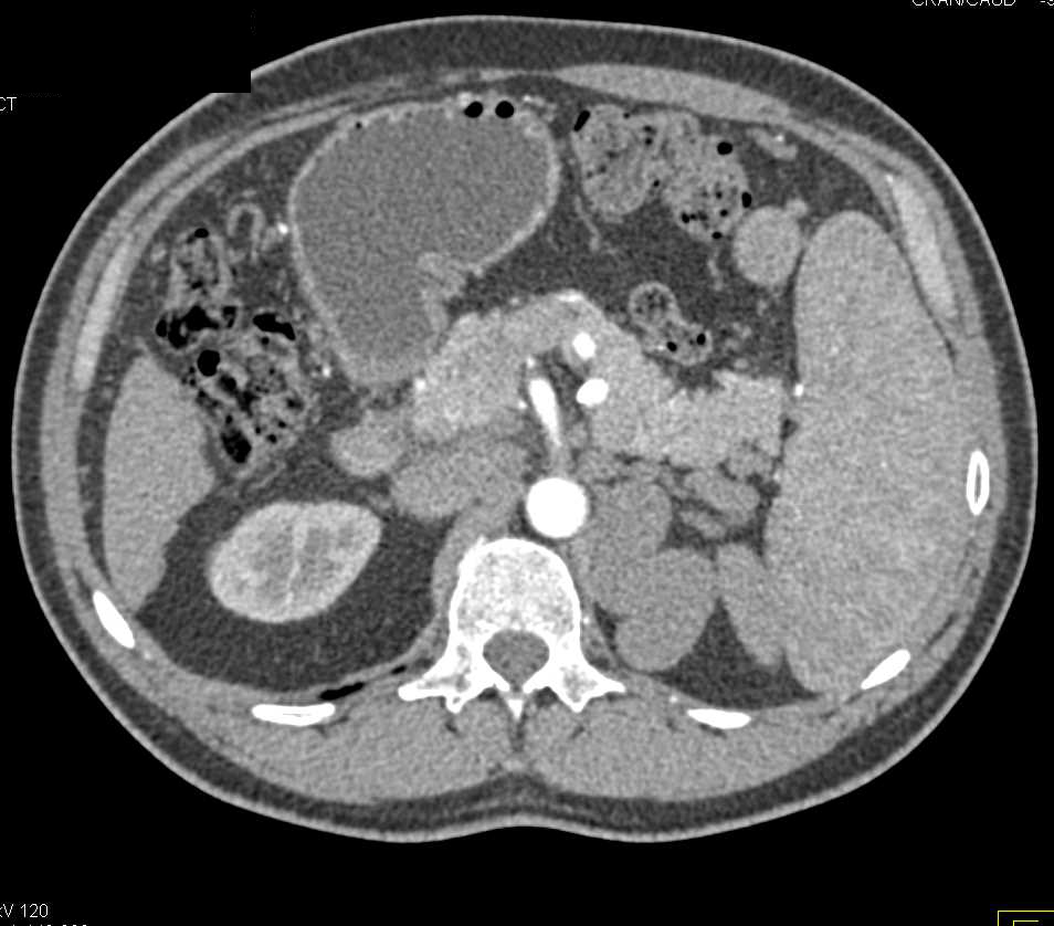 Large Varices Simulate Adenopathy in a Cirrhotic Patient - CTisus CT Scan