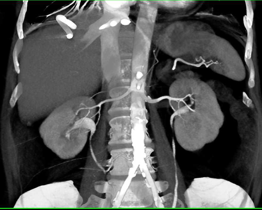 Liver Abscess - CTisus CT Scan
