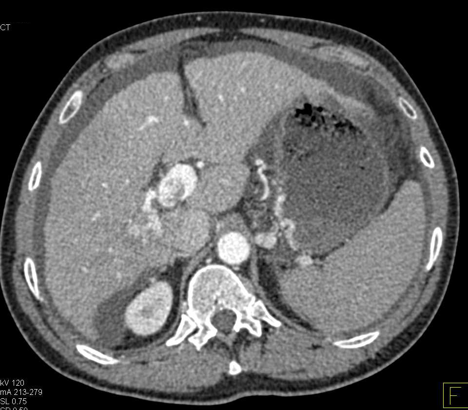 Heptoma Occludes Right Portal Vein with Arteriovenous (AV) Shunting - CTisus CT Scan