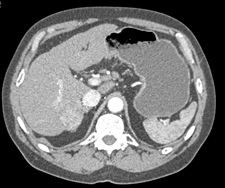 4 cm Hepatocellular Carcinoma (Hepatoma) Right Lobe of Liver - CTisus CT Scan