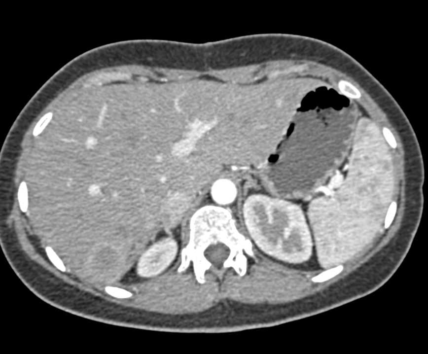 Metastatic Colon Cancer to the Liver - CTisus CT Scan