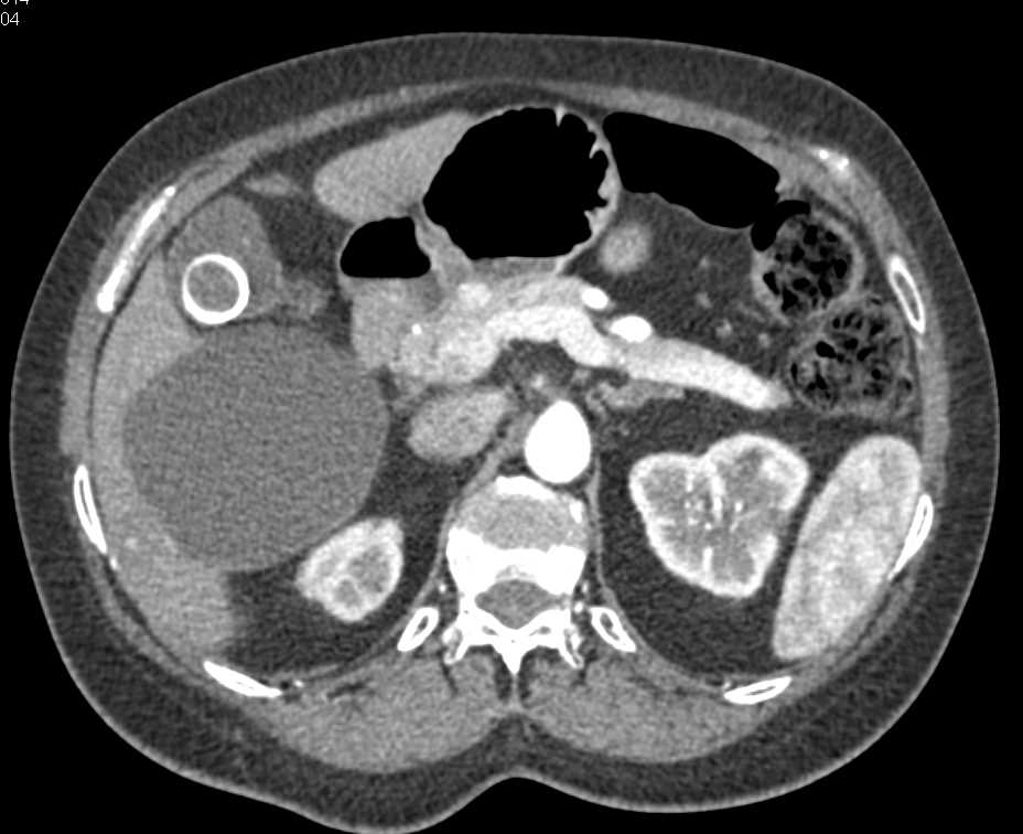 Large Hepatic Cyst - CTisus CT Scan
