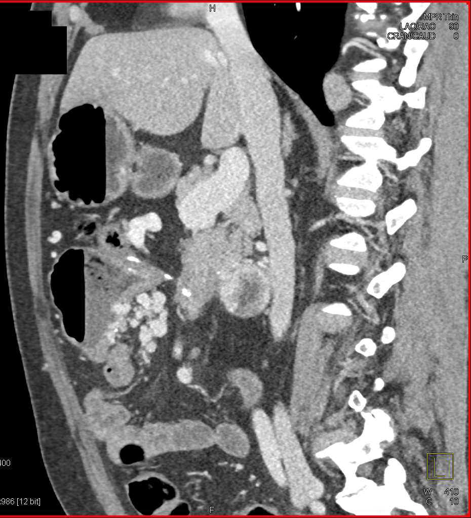 Portal Vein Occlusion with Cavernous Transformation of the Portal Vein (CTPV) and Large Collaterals Seen - CTisus CT Scan