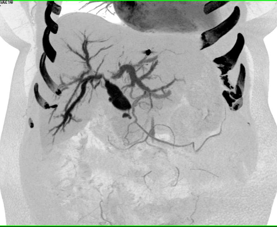 Choledochal Cyst Common Bile Duct with Endoscopic Retrograde Cholangiopancreatography (ERCP) - CTisus CT Scan