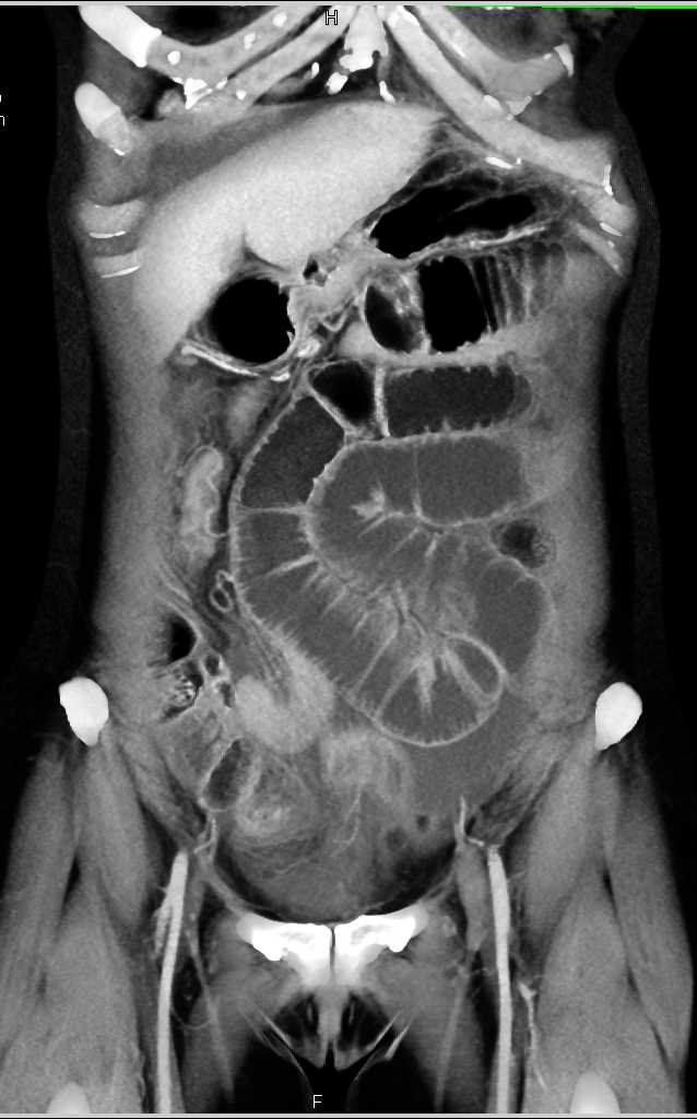 FNH (Focal Nodular Hyperplasia) Liver with Washout - CTisus CT Scan