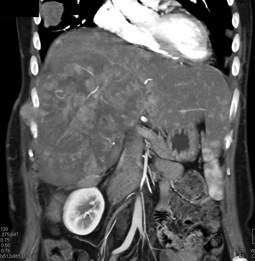 Hepatocellular Carcinoma (Hepatoma) with Widespread Metastatic Disease - CTisus CT Scan