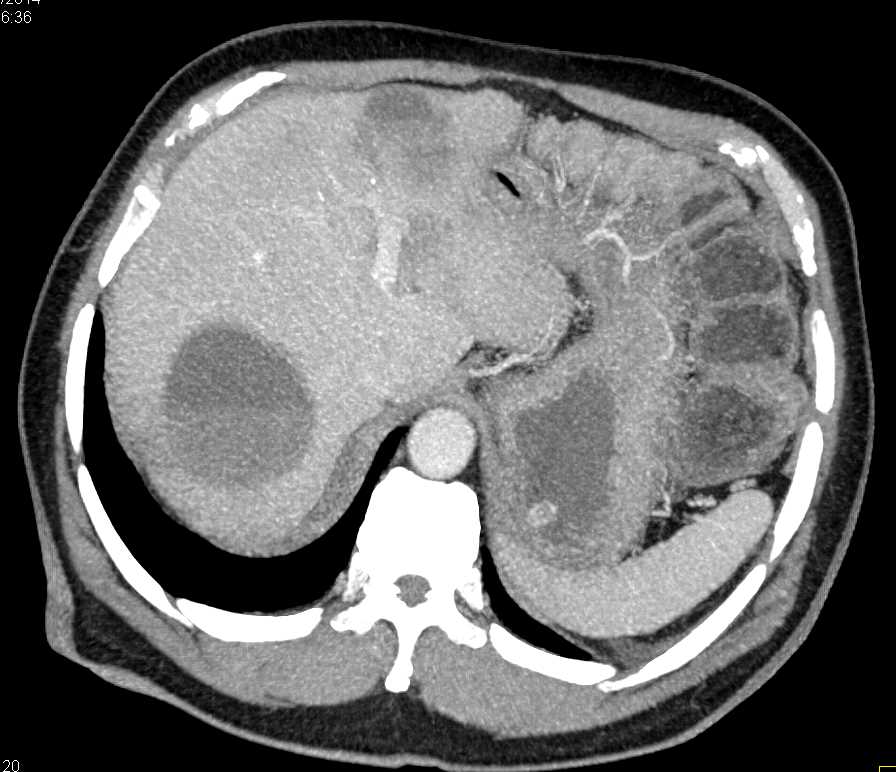 Necrotic Liver Metastases with Fluid-Fluid Levels - CTisus CT Scan
