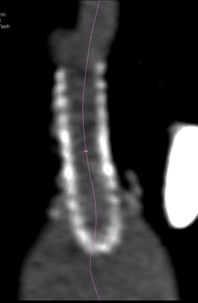 Hepatocellular Carcinoma (Hepatoma) with Vascular Stent that is Narrowed - CTisus CT Scan