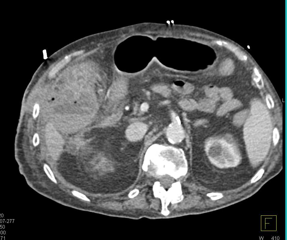 Subhepatic Abscess - CTisus CT Scan