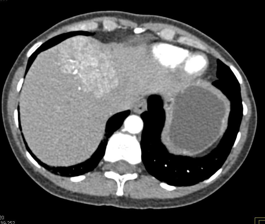 Focal Nodular Hyperplasia (FNH) - CTisus CT Scan