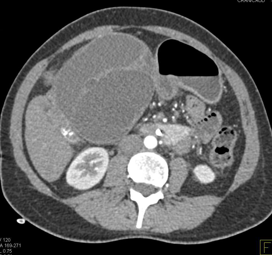 Biliary Cystadenoma - CTisus CT Scan