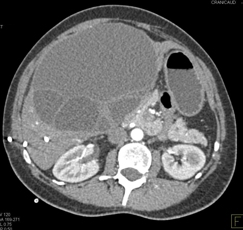 Biliary Cystadenoma - CTisus CT Scan