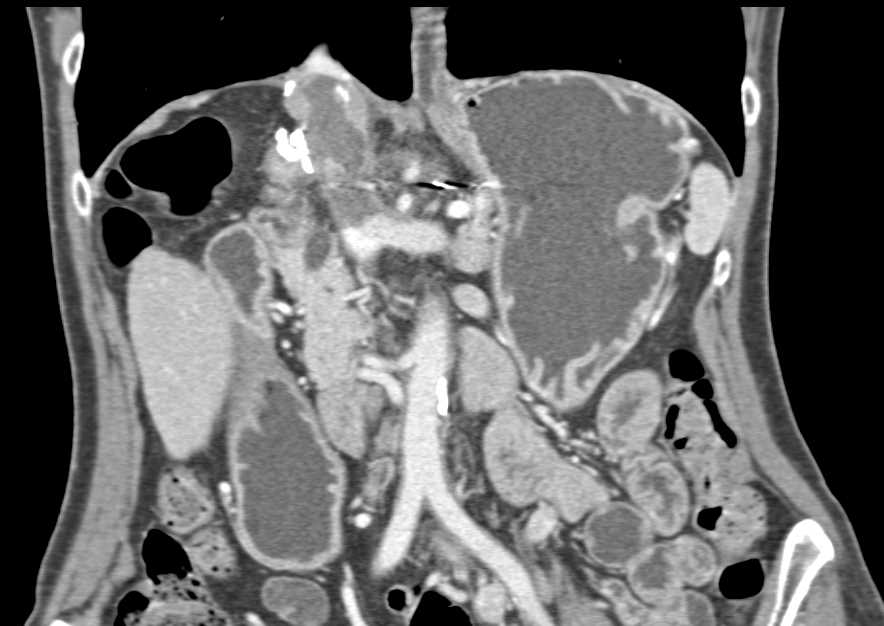 Recurrent Cholangiocarcinoma Involves the Inferior Vena Cava (IVC) - CTisus CT Scan