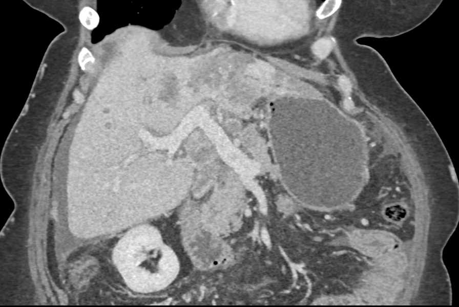 Cholangiocarcinoma of the Liver - CTisus CT Scan
