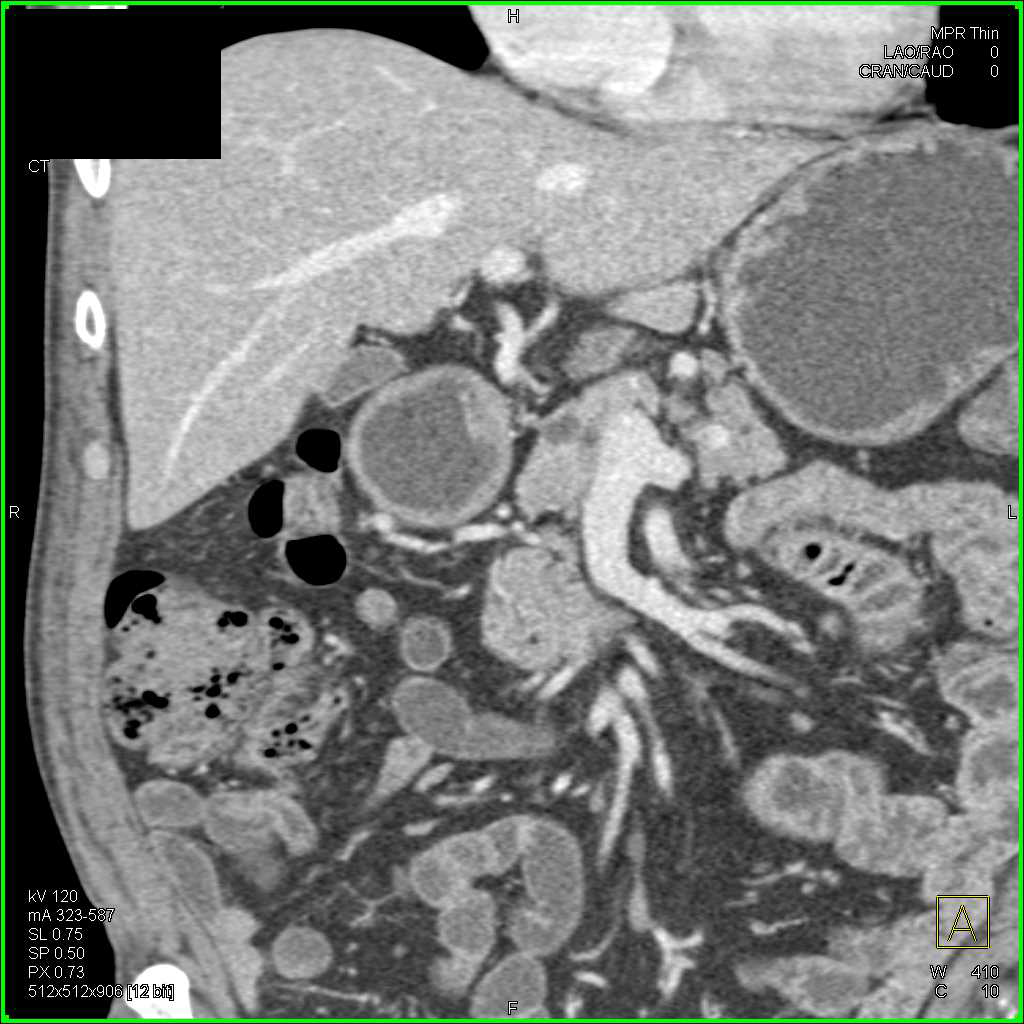 Metastatic Neuroendocrine Tumor to the Liver - CTisus CT Scan
