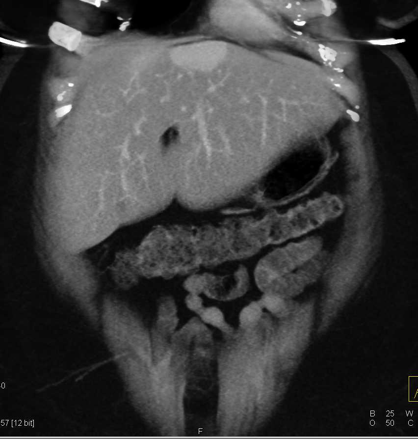 Perfusion Changes in the Liver - CTisus CT Scan