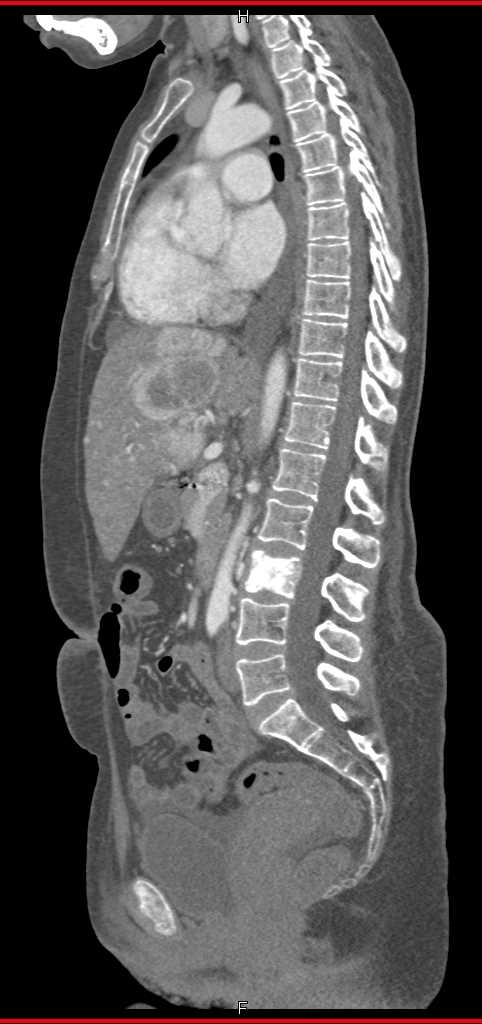 Metastatic Neuroendocrine Tumor to the Liver - CTisus CT Scan