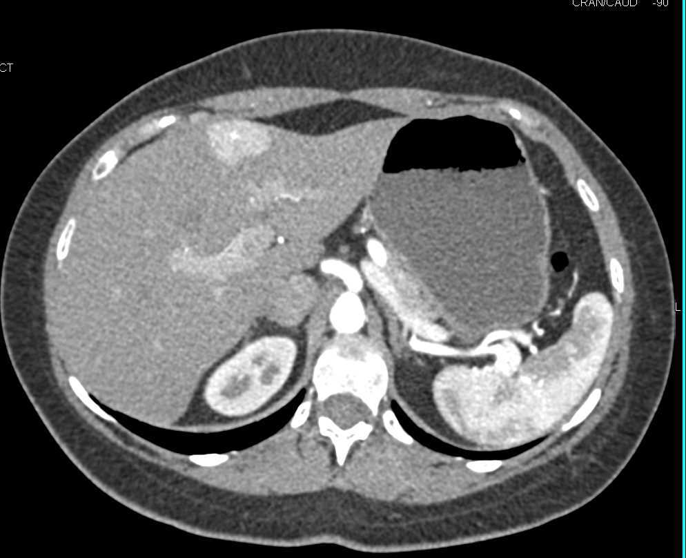 Focal Nodular Hyperplasia (FNH) - CTisus CT Scan