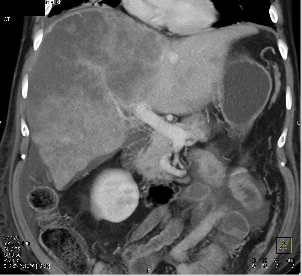 Infiltration Liver with Carcinomatosis due to Gastric Adenocarcinoma with Mutinous Calcifications - CTisus CT Scan
