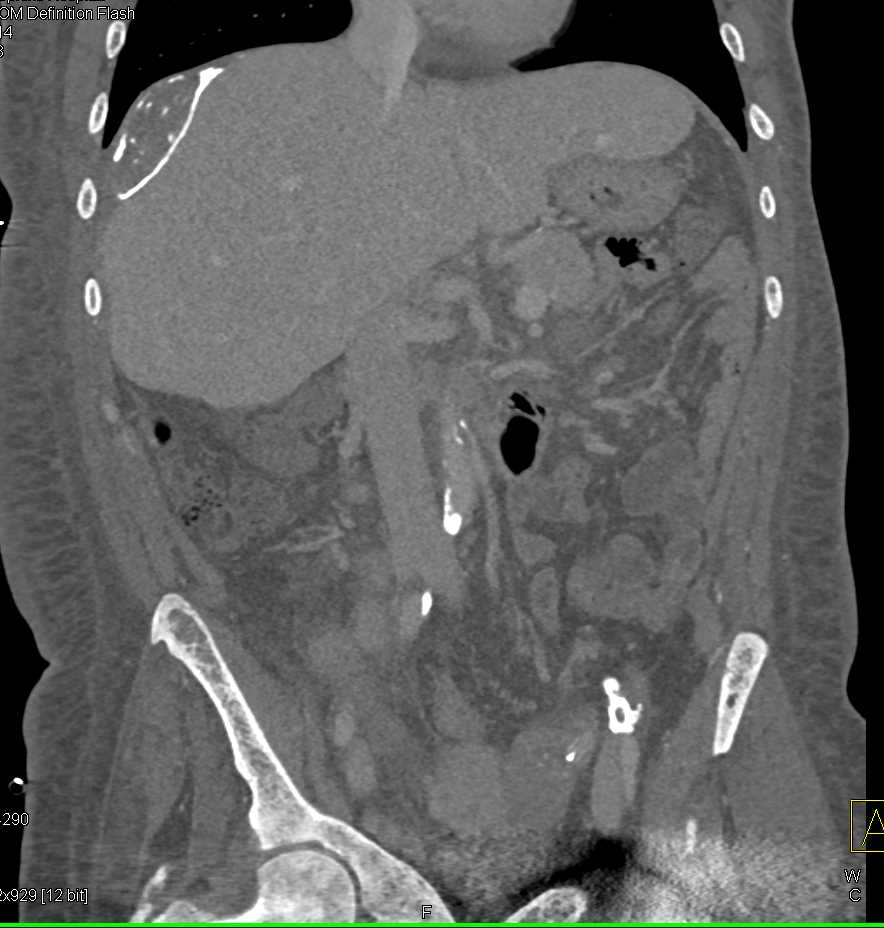 Calcified Subcapsular Cyst by the Liver - CTisus CT Scan