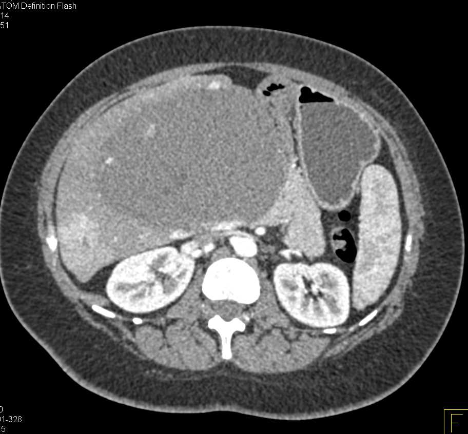 Giant Cavernous Hemangioma of the Liver - CTisus CT Scan