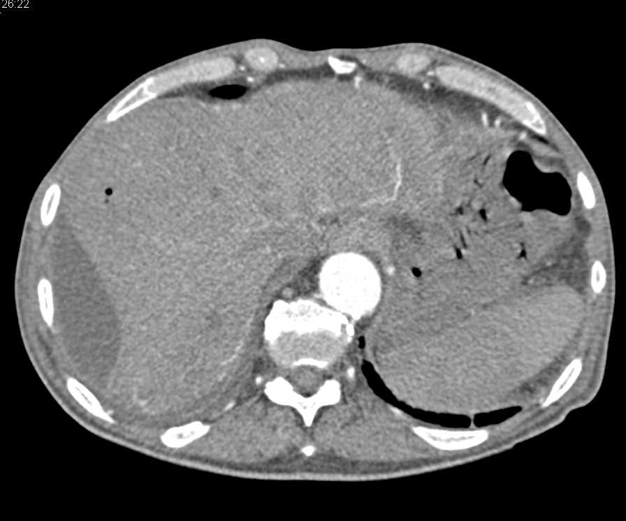 Multiple Liver Abscess with Pneumobilia - CTisus CT Scan