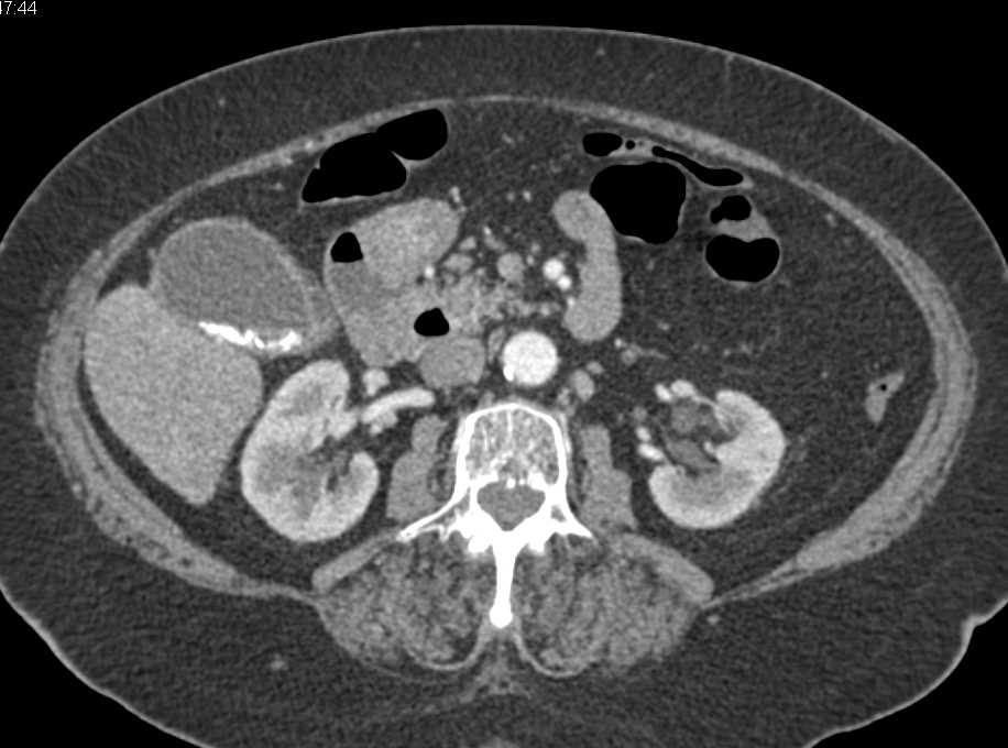 Partially Calcified Common Bile Duct (CBD) Stone in Distal Duct - CTisus CT Scan