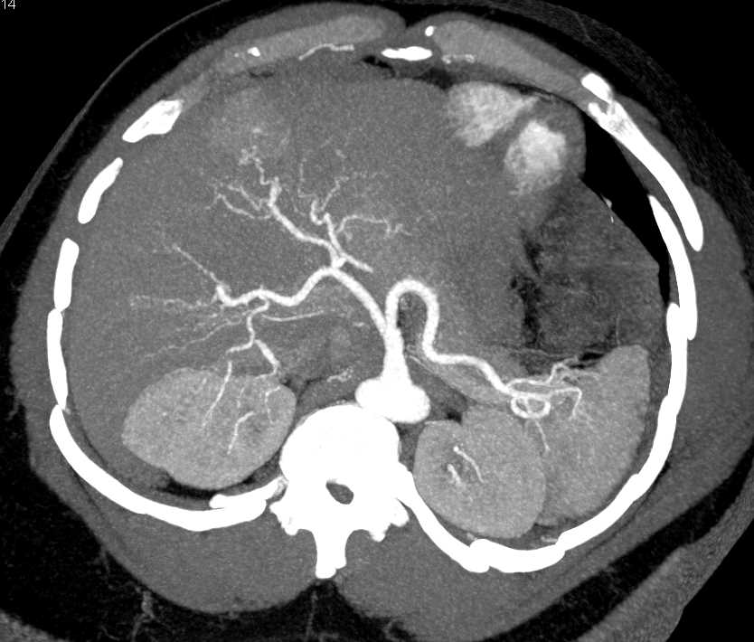 Multifocal Hepatocellular Carcinoma (Hepatoma) - CTisus CT Scan