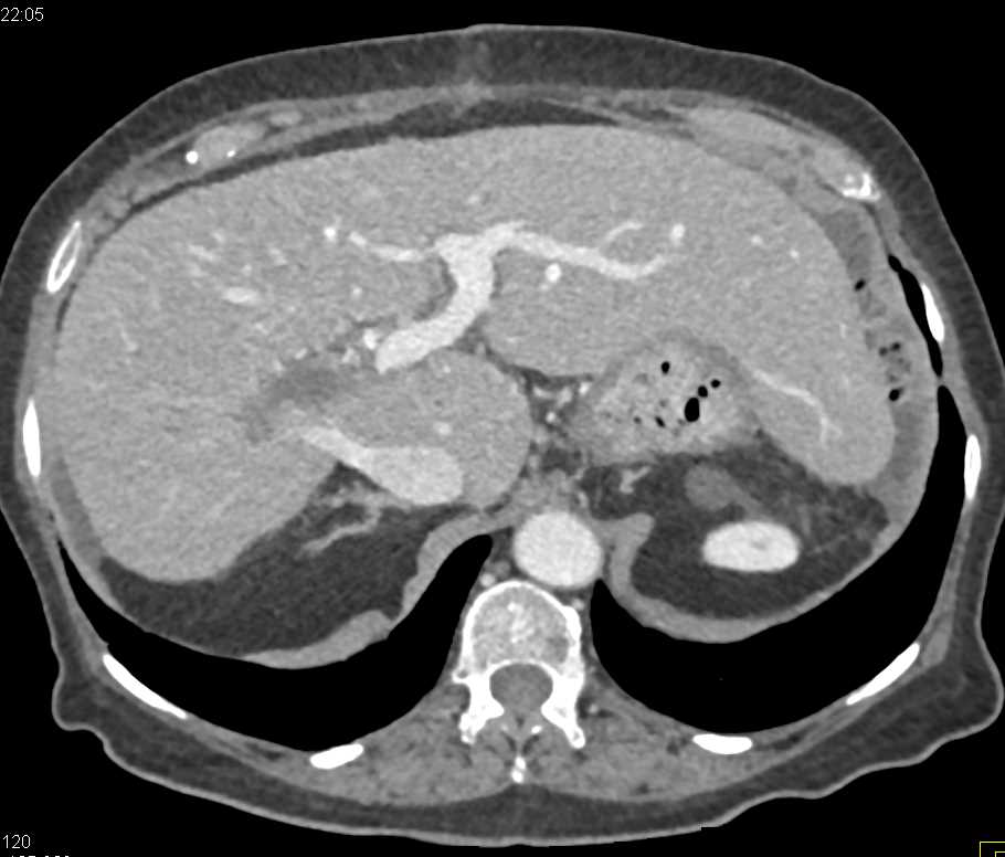 Cirrhosis with Portal Vein Thrombosis - CTisus CT Scan