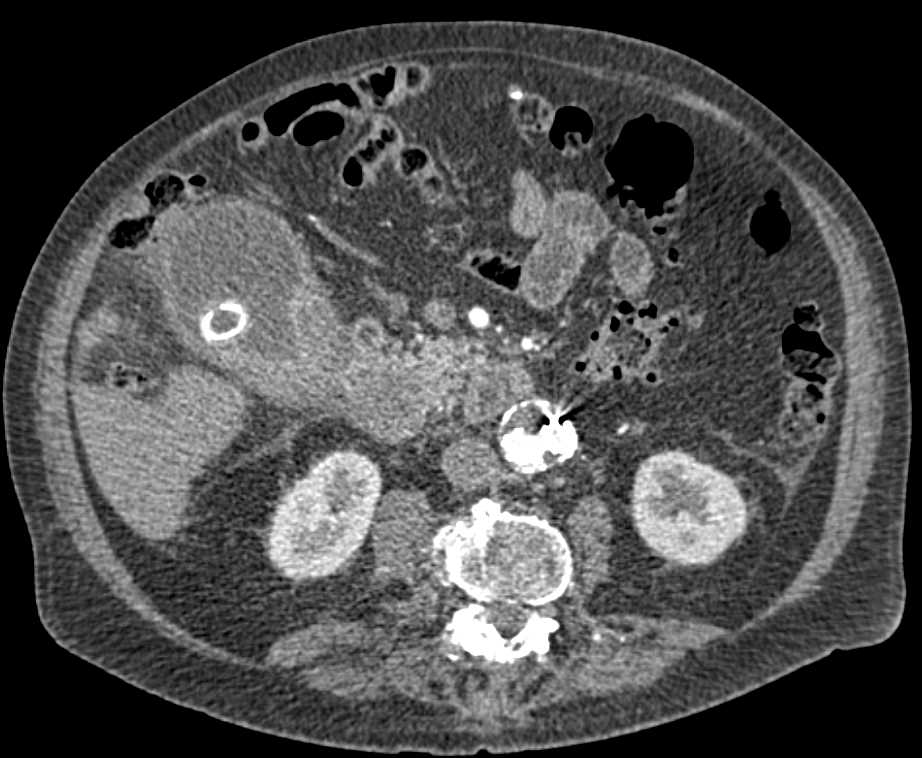 Invasive Gallbladder Cancer - CTisus CT Scan