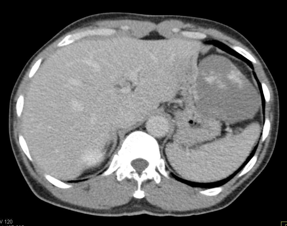 Hepatic Hemangioma is Exophytic in Location and Simulates a Gastric Mass - CTisus CT Scan