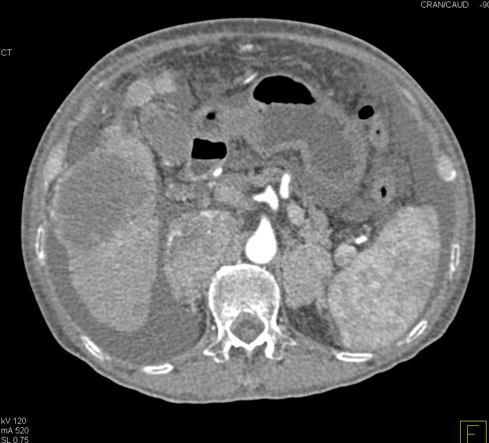 Hepatocellular Carcinoma (Hepatoma) with Bilateral Adrenal Metastases - CTisus CT Scan