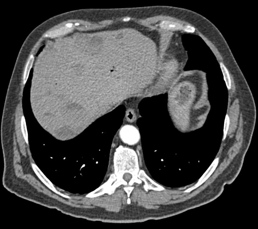 Cystic Liver Metastases - CTisus CT Scan