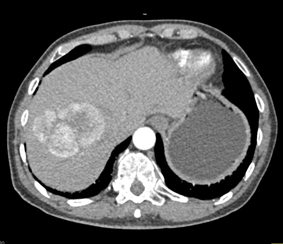 Hepatocellular Carcinoma (Hepatoma) with Pseudocapsule - CTisus CT Scan