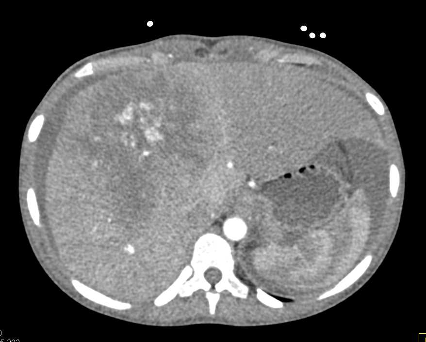 Multifocal Hepatocellular Carcinoma (Hepatoma) with Ascites - CTisus CT Scan