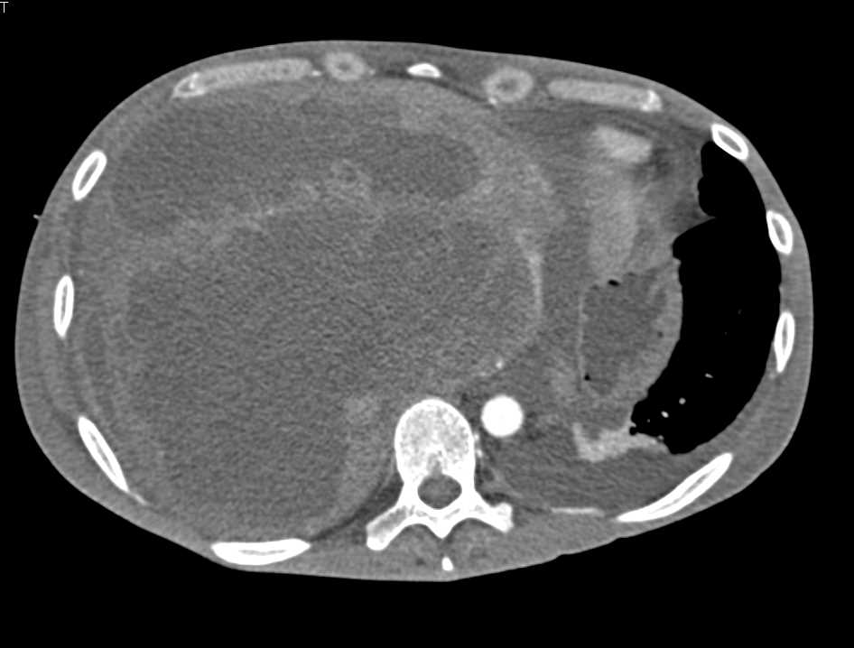 Metastatic Leiomyosarcoma to the Liver - CTisus CT Scan