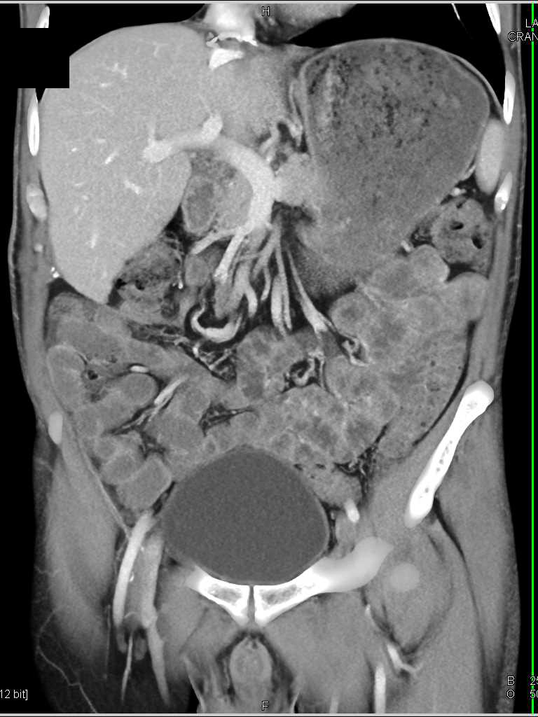 Liver Abscess Liver Case Studies Ctisus Ct Scanning