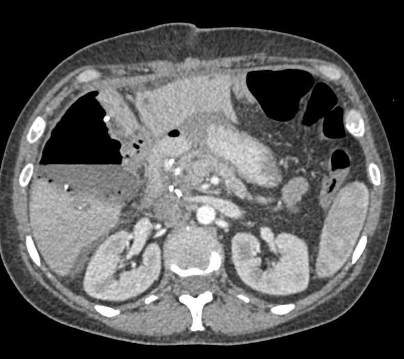 Abscess in Liver Near Resection Site - CTisus CT Scan