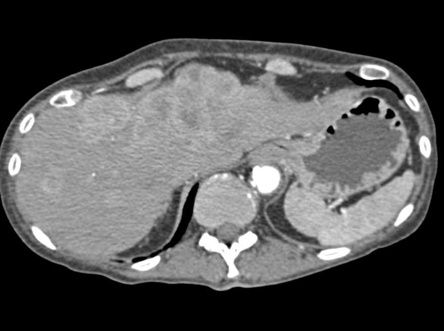 Widespread GI Metatsases to Liver - CTisus CT Scan