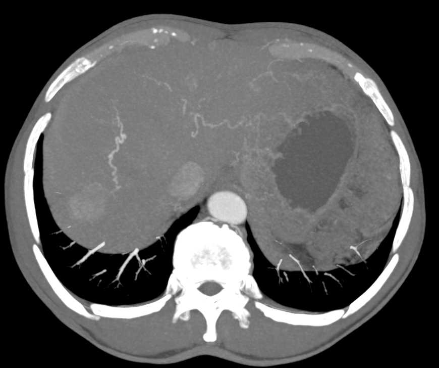 Hepatic Hemangioma on CTA - CTisus CT Scan