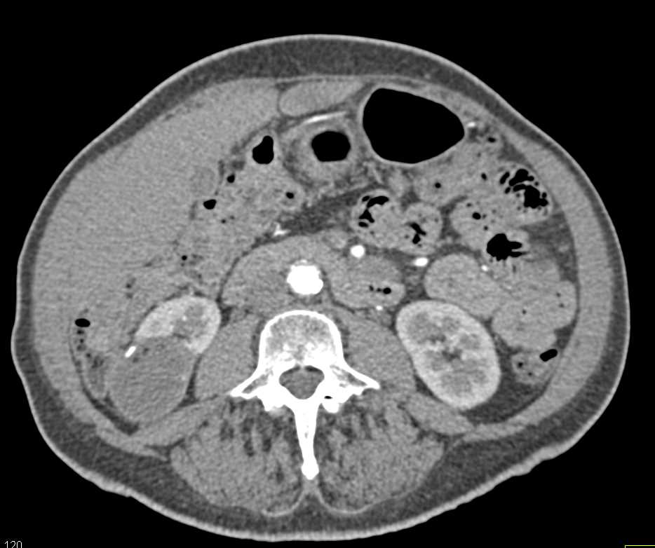 Post Partial Right Nephrectomy - CTisus CT Scan