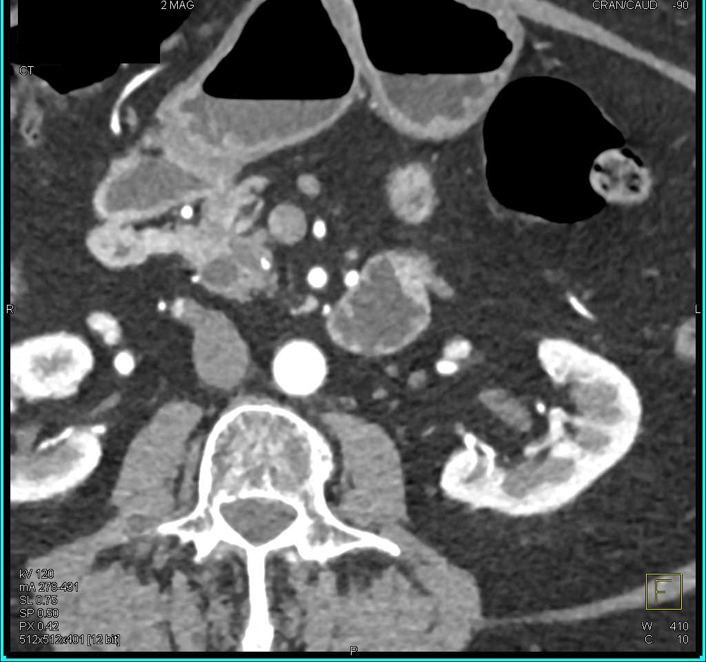 Ampullary Tumor Obstructs the Common Bile Duct (CBD) in 3D - CTisus CT Scan