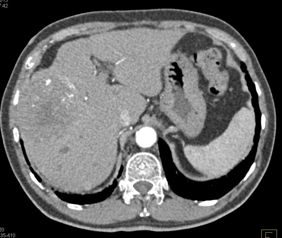 Hepatocellular Carcinoma (Hepatoma) with a Pseudocapsule - CTisus CT Scan