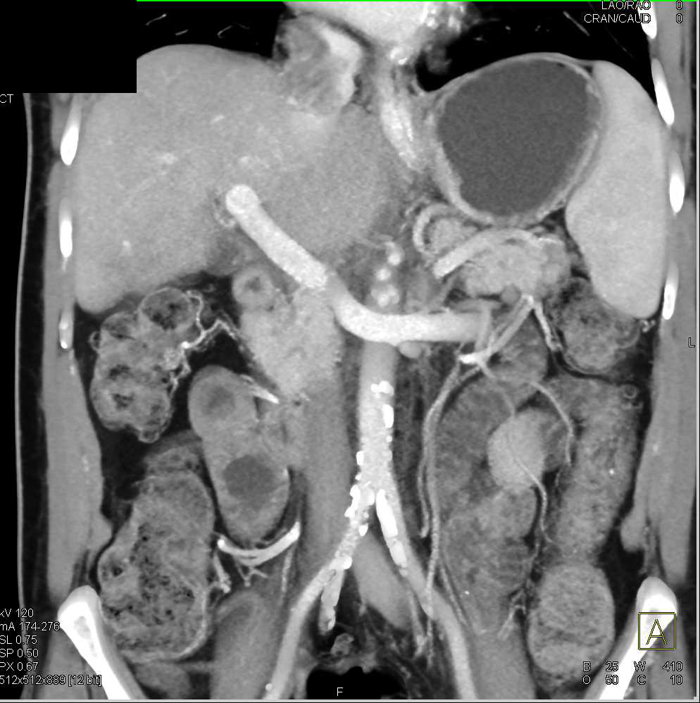 Hepatocellular Carcinoma (Hepatoma) Invades the Inferior Vena Cava (IVC) - CTisus CT Scan