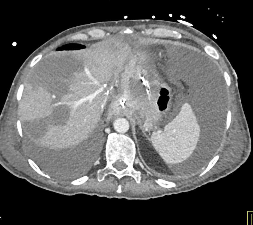 Post Operative Complications Including Liver Infarction and Deep Vein Thrombosis (DVT) in Right Femoral Vein - CTisus CT Scan